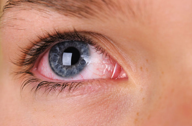 Bloodshot Eyes and DUI – Does it Mean Anything in a DUI Case?